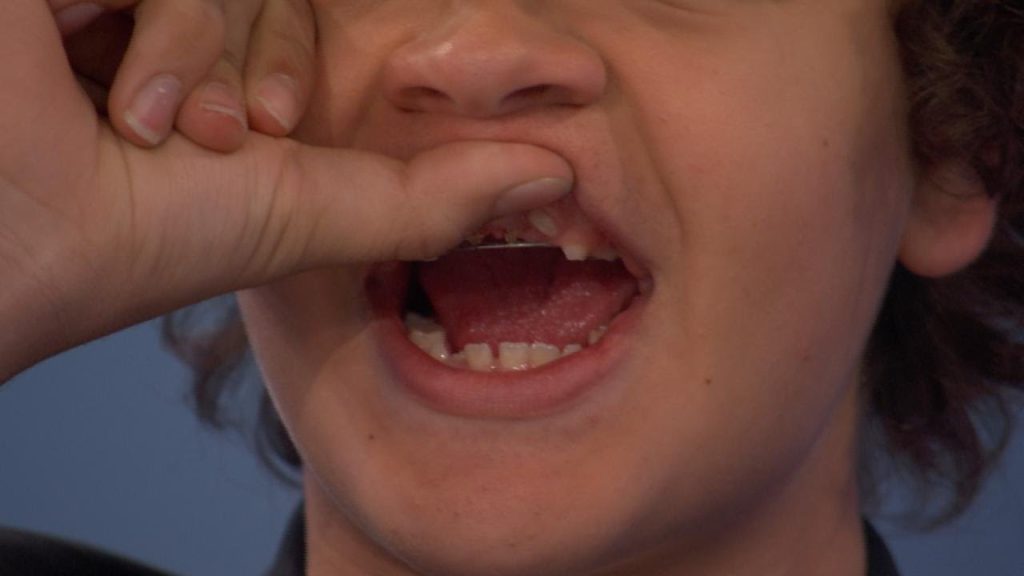 Gaten Matarazzo Teeth - what happened to them